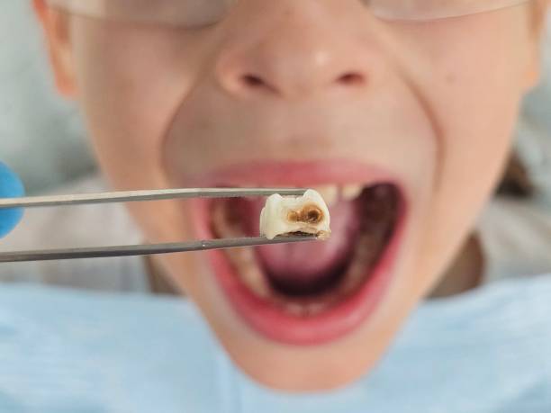 Best Emergency Dentist for Special Needs Patients in Chesterfield, IN